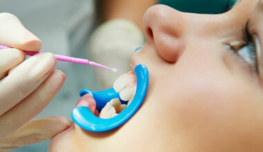 decode the science behind high fluoride dental care a deep dive into duraphat and oral protection