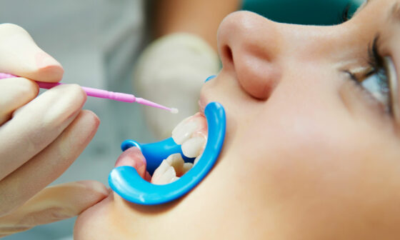 decode the science behind high fluoride dental care a deep dive into duraphat and oral protection