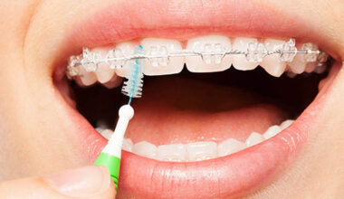 Braces Maintenance