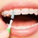 Braces Maintenance