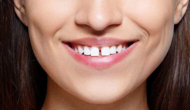 How to Repair Chipped or Gapped Teeth Without Major Surgery