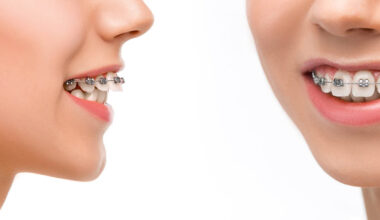 Ways Braces in Kelowna Help Correct Bite Problems