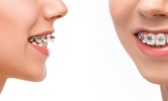 Ways Braces in Kelowna Help Correct Bite Problems