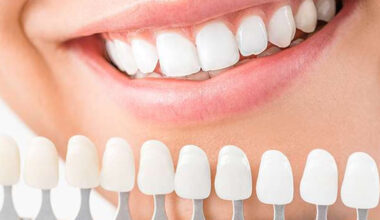 Are Dental Veneers in Edison the Right Choice for Your Smile