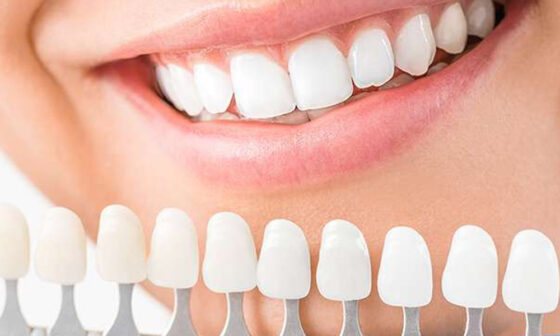 Are Dental Veneers in Edison the Right Choice for Your Smile