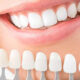 Are Dental Veneers in Edison the Right Choice for Your Smile