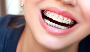 Getting Clear Braces
