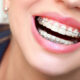 Getting Clear Braces