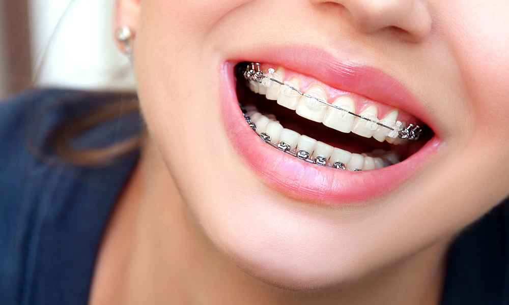 Getting Clear Braces