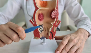 How To Find a Good Clinic For Hemorrhoid Artery Embolization