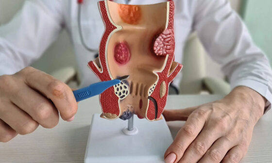 How To Find a Good Clinic For Hemorrhoid Artery Embolization