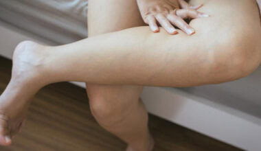 Signs You May Be a Good Candidate for Varithena Treatment
