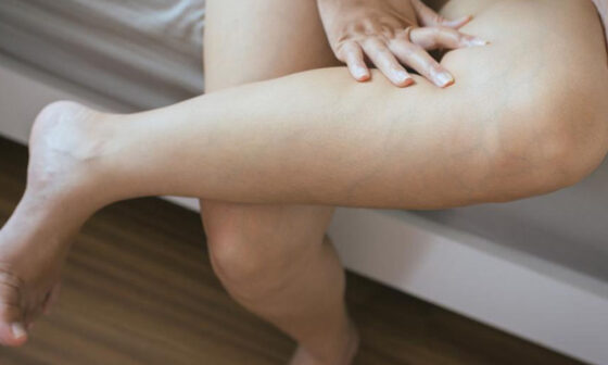 Signs You May Be a Good Candidate for Varithena Treatment