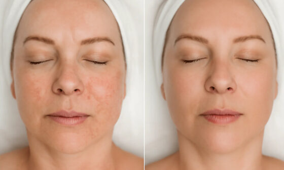 The Latest in Non Invasive Laser Treatments