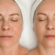 The Latest in Non Invasive Laser Treatments