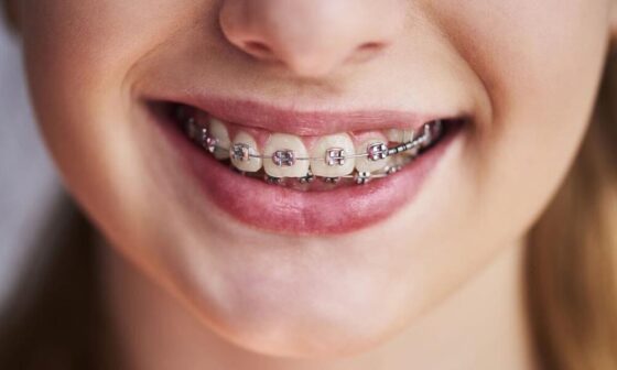 The Role of Orthodontists in Easing TMJ Discomfort in Chantilly