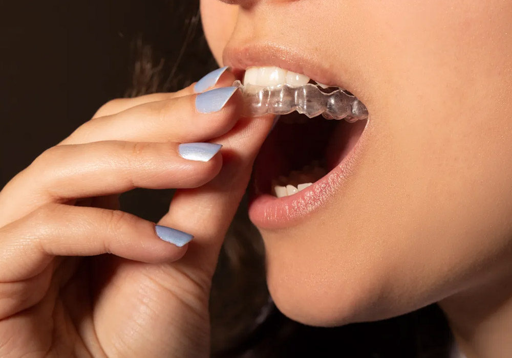 5 Best Clear Aligners for Teeth Straightening in the UK