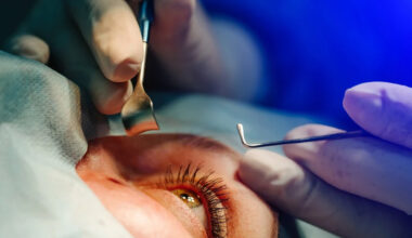 Cataract Surgery