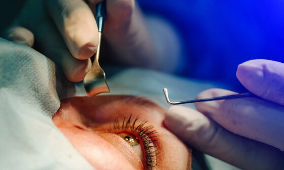 Cataract Surgery