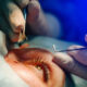 Cataract Surgery