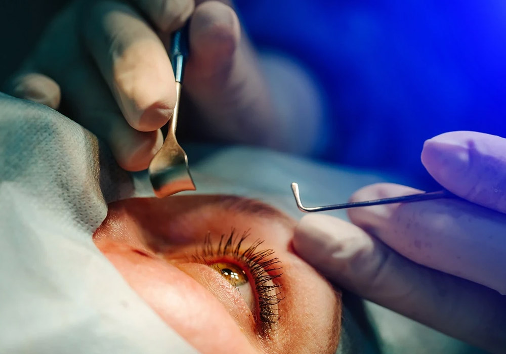 Cataract Surgery