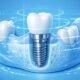 Modern Innovations in Dental Implant Technology What Patients Need to Know