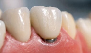 5 Best Dental Implant Providers Serving Southeast Missouri And Northeast Arkansas