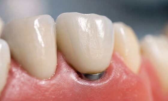5 Best Dental Implant Providers Serving Southeast Missouri And Northeast Arkansas