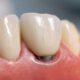 5 Best Dental Implant Providers Serving Southeast Missouri And Northeast Arkansas