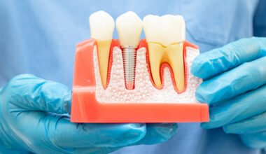 A Complete Guide to Navigating Tooth Loss and Choosing the Right Restoration Option
