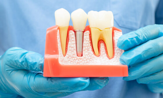 A Complete Guide to Navigating Tooth Loss and Choosing the Right Restoration Option