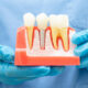 A Complete Guide to Navigating Tooth Loss and Choosing the Right Restoration Option