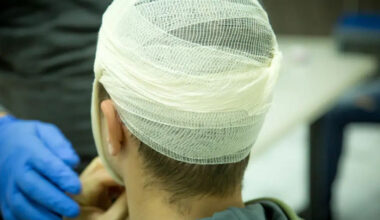 What Injured Workers Should Know About Brain Injury Claims in San Francisco