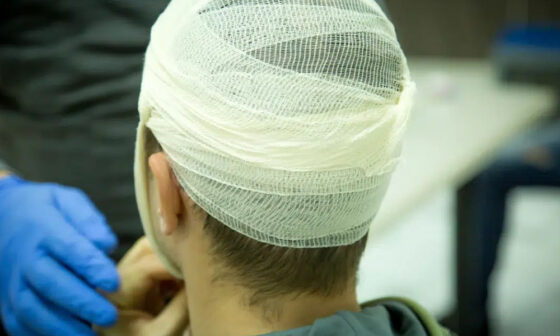 What Injured Workers Should Know About Brain Injury Claims in San Francisco