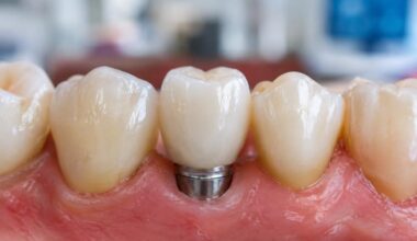 The Tooth Replacement Checklist Fit Function Time And Care In St. Louis Missouri