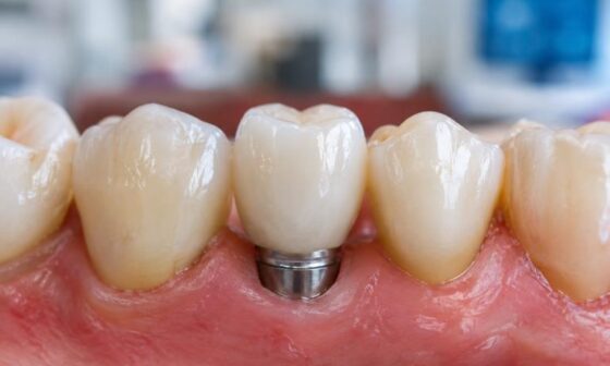 The Tooth Replacement Checklist Fit Function Time And Care In St. Louis Missouri