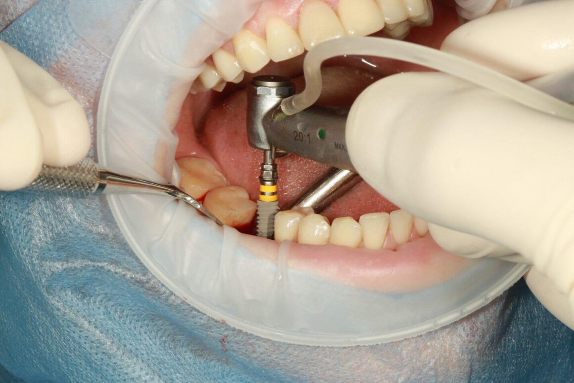 What to Know Before Choosing Dental Implants