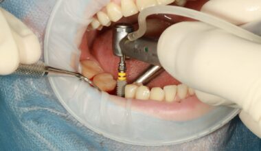 What to Know Before Choosing Dental Implants
