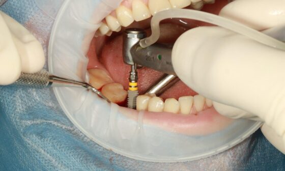 What to Know Before Choosing Dental Implants