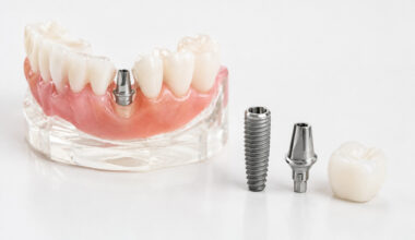 5 Businesses Supporting a Complete Dental Implant Journey in Richmond Virginia